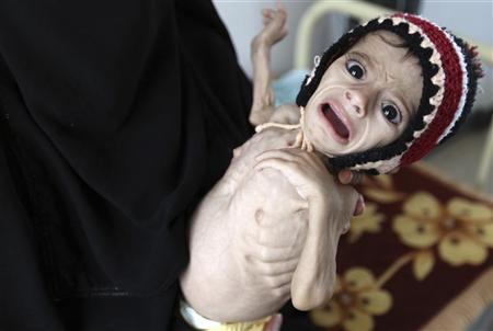 منظمة دولية : 15 ألف طفل يمني يعانون من سوء تغذية حاد